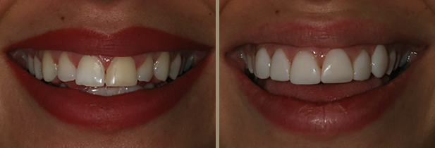Composite Bonding London