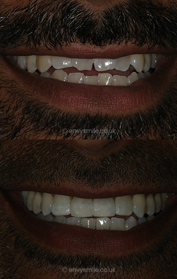 Invisalign