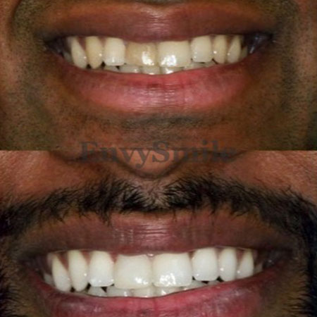 Teeth Whitening