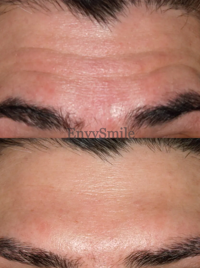 Wrinkle Reduction