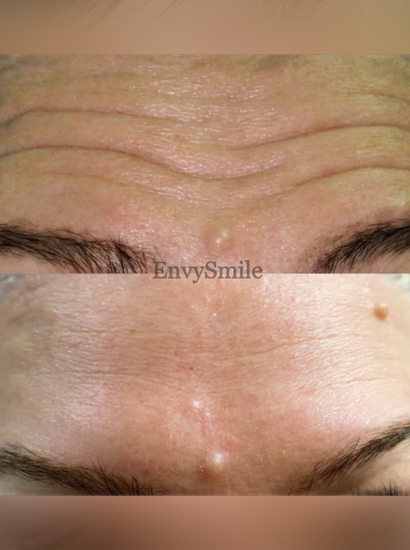 Wrinkle Reduction